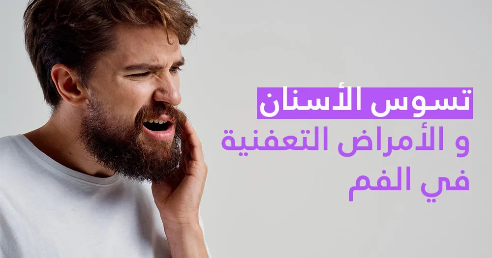 تسوّس الأسنان و الأمراض التّعفنية في الفم
